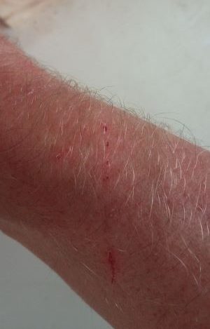 my dog bit me and drew blood e1637665779466